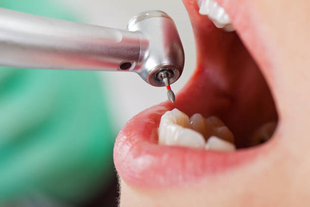 Best Emergency Wisdom Teeth Removal in Pacific City, OR